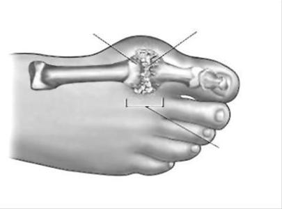 贵阳强直医院痛风的治疗方法
