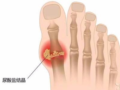 贵阳痛风专科医院专家解析：痛风是不是一种关节破坏疾病？