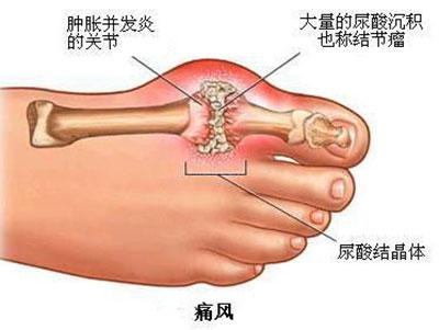 痛风来临忍无可忍？痛风的治疗要趁早千万别忍！