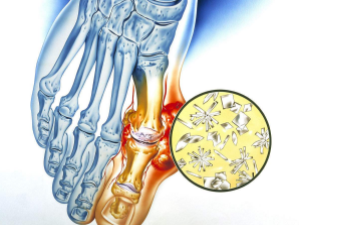贵阳医治痛风最好的医院专家为患者总结了药物医治痛风可能发生的几个误区。