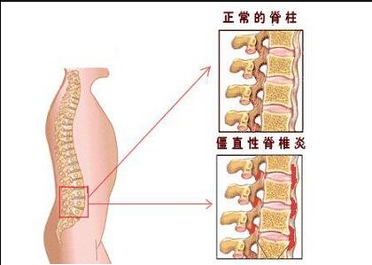 贵阳中医风湿口碑怎么样 强直性脊柱炎怎么回事呢